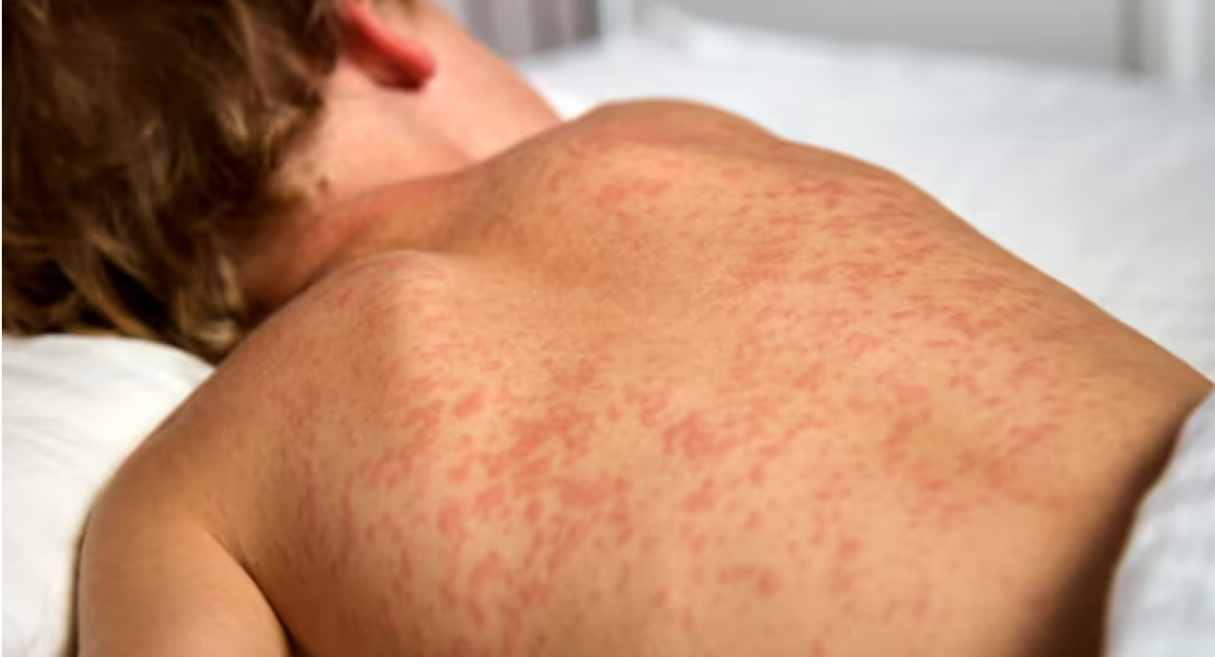 Measles